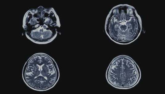 大脑CT扫描动画1高清在线视频素材下载