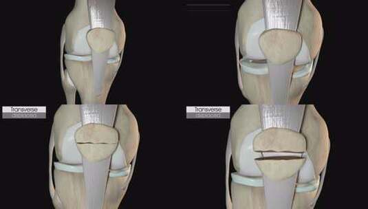 髌骨骨折横向移位高清在线视频素材下载