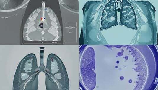 人体肺部的医学影像高清在线视频素材下载