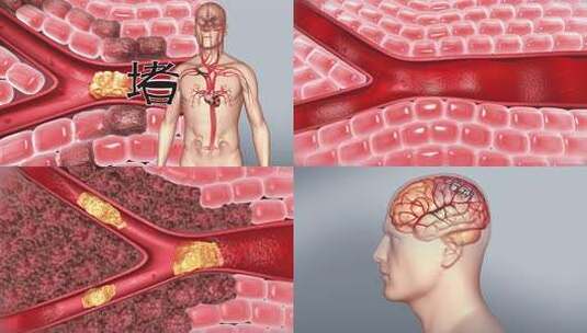 脑康复畅通血管 脑血栓 心梗脑梗 血液流动高清在线视频素材下载