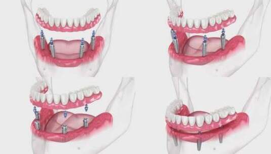 4个植入物支持的假体。牙科3D动画高清在线视频素材下载