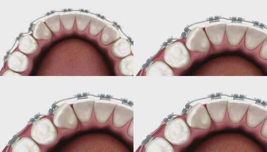 带牙套的丘比特矫正。医学上准确的牙科3D高清在线视频素材下载