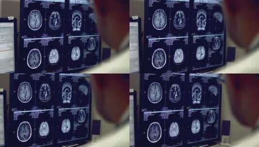 医生看脑部CT高清在线视频素材下载