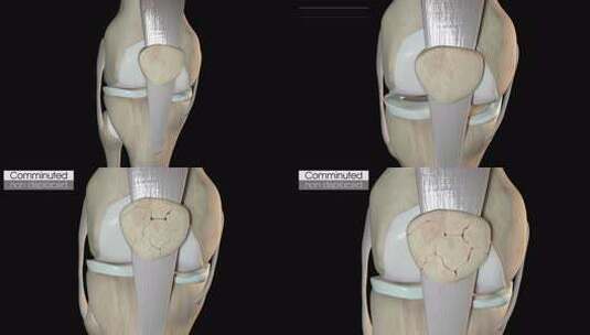 髌骨粉碎性骨折非移位高清在线视频素材下载