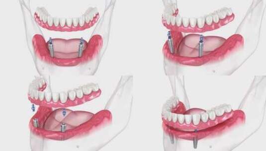 下颌可拆卸假体All on 2系统由带有高清在线视频素材下载