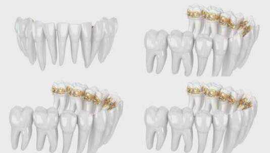 舌金色牙套系统。牙科3D动画高清在线视频素材下载