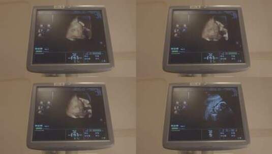 怀孕B超 超声波 孕妇 怀孕 婴儿高清在线视频素材下载