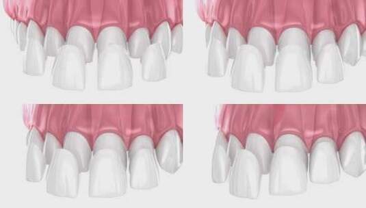 中切牙和侧切牙上的牙贴面放置。3D动画高清在线视频素材下载