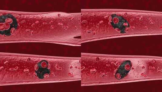 深静脉血栓或血液的 3D动画高清在线视频素材下载