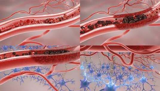 血管堵塞 脑血栓 大脑神经死亡 脑梗高清在线视频素材下载