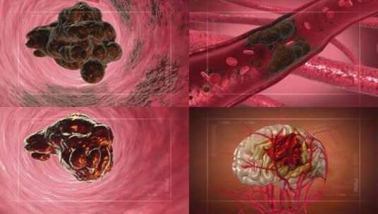 人体血液 血管 血管堵塞 自由基 粥样硬化高清在线视频素材下载