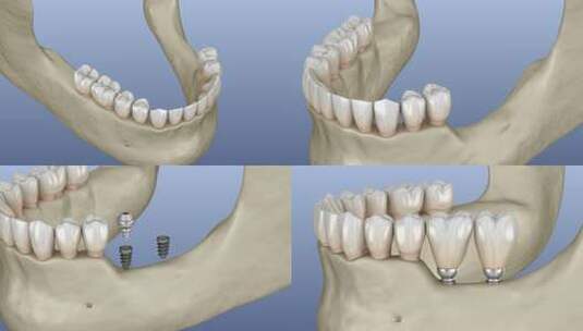 微型植入物植入下颌骨：医学上精确的3D动高清在线视频素材下载