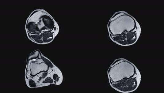 右膝关节磁共振成像（MRI）高清在线视频素材下载