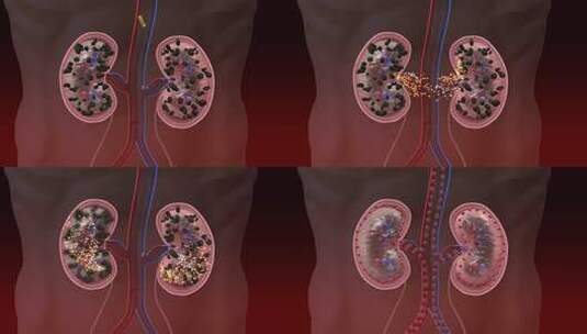 3D 渲染动画 - 肾脏疼痛缓解高清在线视频素材下载