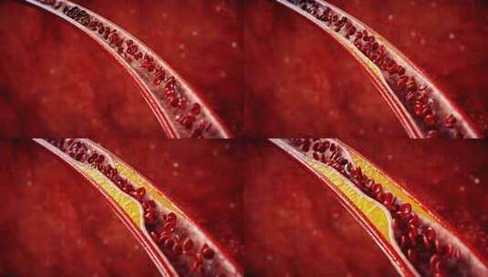 动脉硬化疾病3D动画演示高清在线视频素材下载
