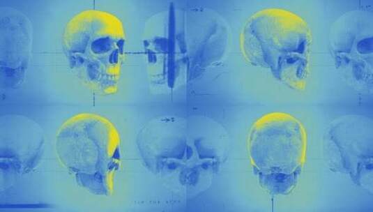 病历头骨02高清在线视频素材下载