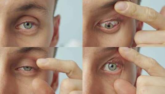 一个男人疼痛的眼睛特写镜头用手指张开高清在线视频素材下载