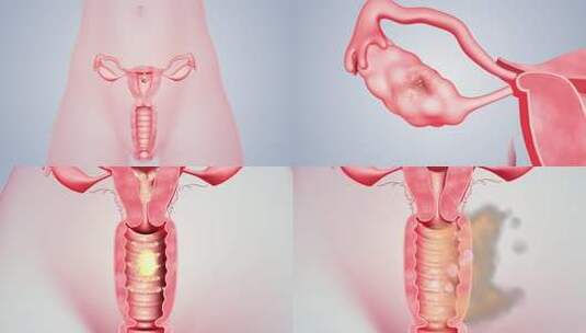 子宫肌瘤  卵巢囊肿 妇科疾病 女性健康高清AE视频素材下载