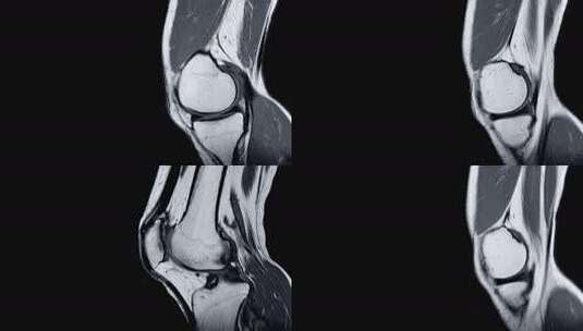 右膝关节磁共振成像（MRI）高清在线视频素材下载