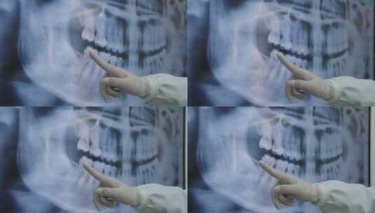 手术牙齿x光高清在线视频素材下载