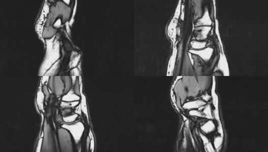 腕部核磁 手腕MRI影像 黑白影像 8高清在线视频素材下载