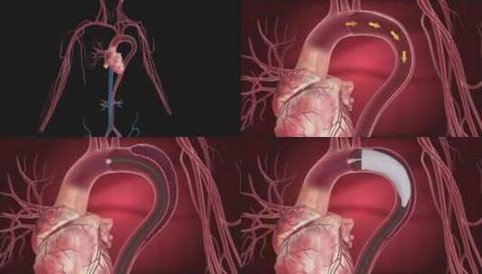 3d心脏动脉血管手术愈合血液循环动力动画高清在线视频素材下载