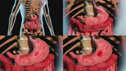 胃溃疡的形成高清在线视频素材下载