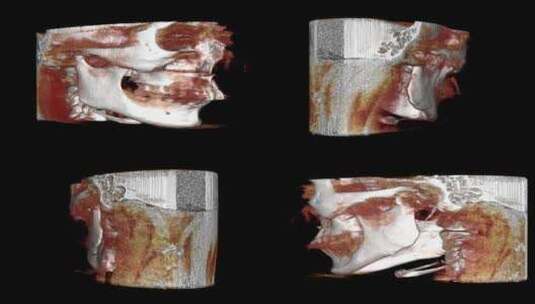 口腔CBCT 冠状位 头部3D 牙齿CT高清在线视频素材下载