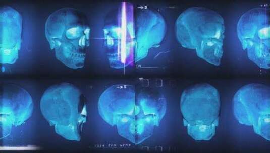 头骨X射线高清在线视频素材下载