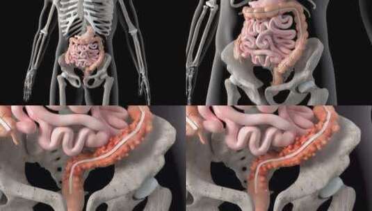 肠憩室概述高清在线视频素材下载