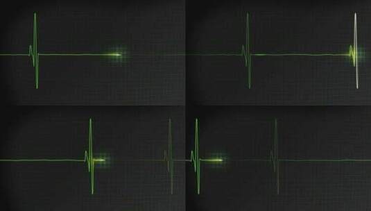 3个EKG心跳显示监视器视频高清在线视频素材下载