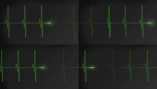 3个EKG心跳显示监视器视频高清在线视频素材下载