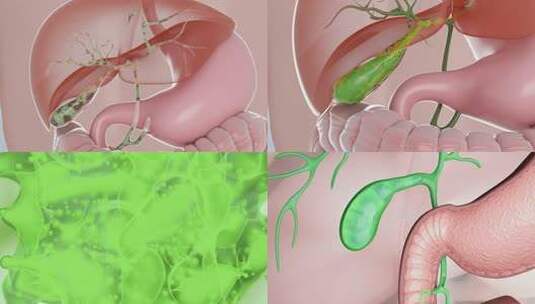 胆囊 胆囊炎 胆汁分泌 消化系统高清在线视频素材下载