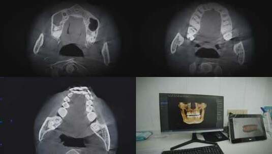 口腔科扫描牙齿高清在线视频素材下载