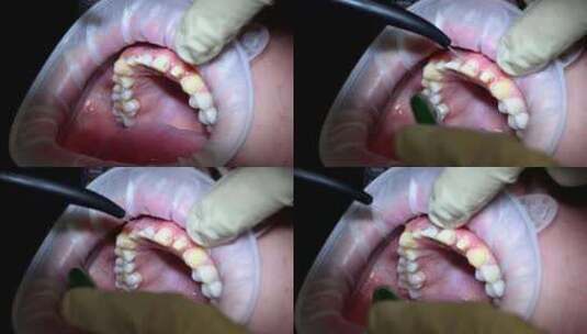 专业牙医对女性牙齿进行全面检查，检查蛀牙高清在线视频素材下载