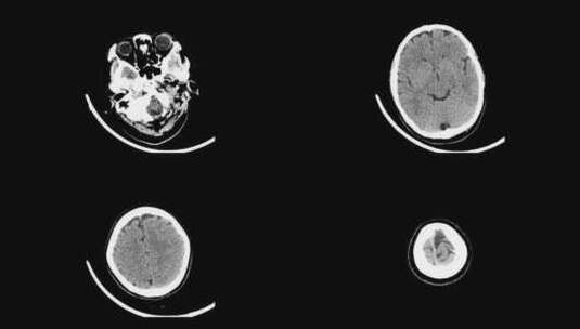 动态头部CT影像 头骨CT影像高清在线视频素材下载