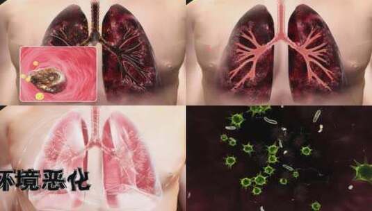 呼吸疾病 气管炎 慢性支气管炎 肺病高清在线视频素材下载