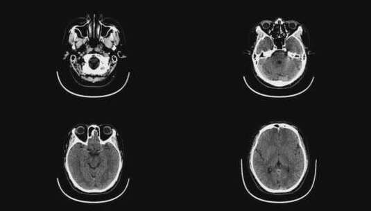 动态头部CT影像 头骨CT影像高清在线视频素材下载
