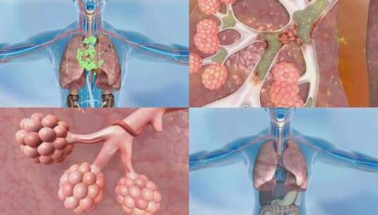修复激活肺泡 肺泡 肺泡塌陷 肺毒素高清在线视频素材下载