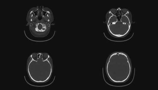 动态头部CT影像 头骨CT影像高清在线视频素材下载