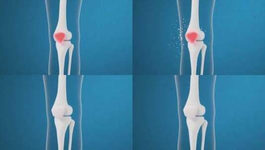 人体骨骼膝盖修复医学动画高清在线视频素材下载