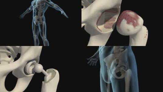 全髋置换术高清在线视频素材下载