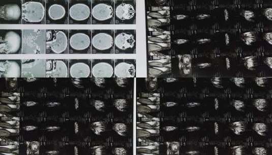 医疗素材头部ct拍片分析结果高清在线视频素材下载