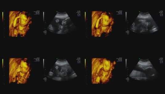 婴儿在母体里活动超声波影像高清在线视频素材下载