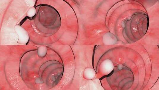 肠息肉概述高清在线视频素材下载
