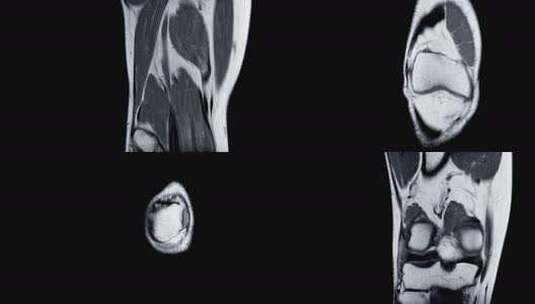 右膝关节磁共振成像（MRI）高清在线视频素材下载