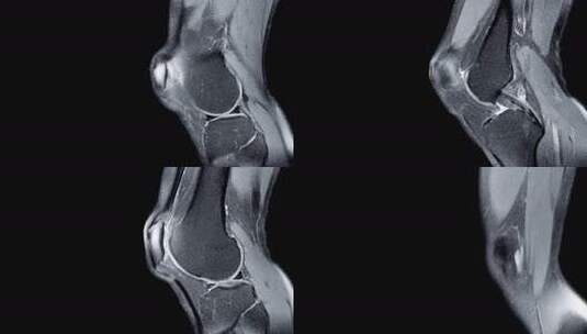 右膝关节磁共振成像（MRI）高清在线视频素材下载