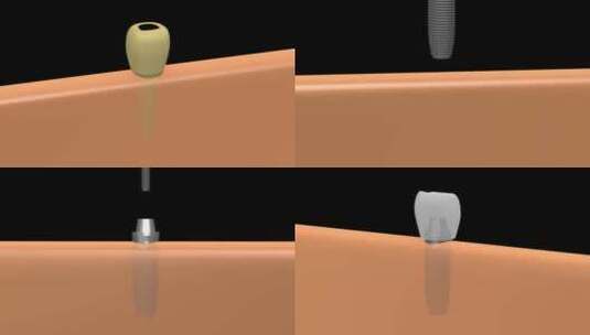 牙齿修复牙科医学动画高清在线视频素材下载