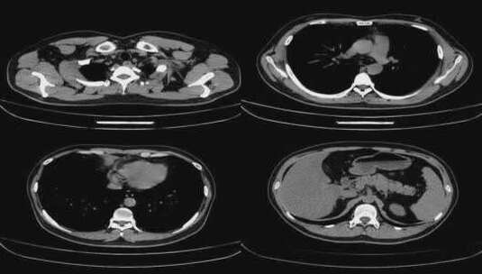 动态肺部CT影像 胸部CT影像 腹部CT高清在线视频素材下载