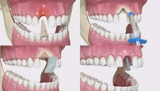 骨移植增高、牙槽保存、牙齿植入高清在线视频素材下载